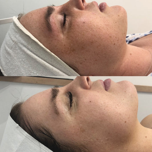 Can Dermapen Treatment Fix Your Acne Scars?