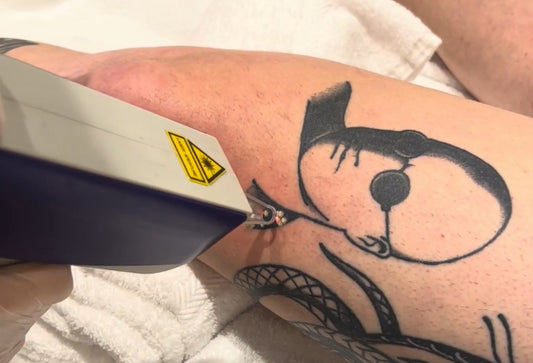 Does Laser Tattoo Removal Work?