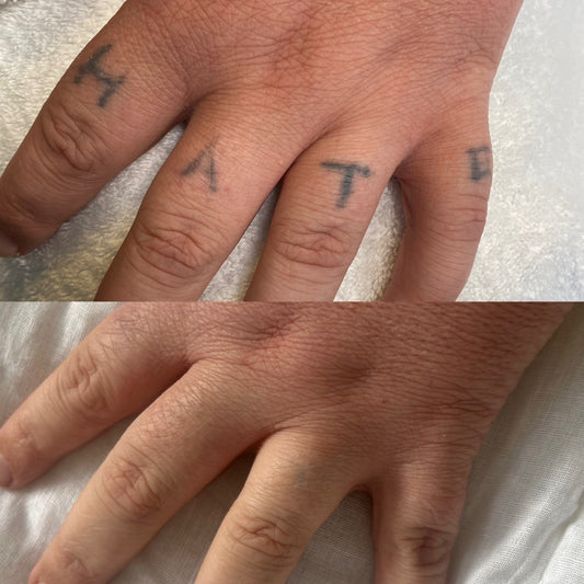 Tattoo removal before and after