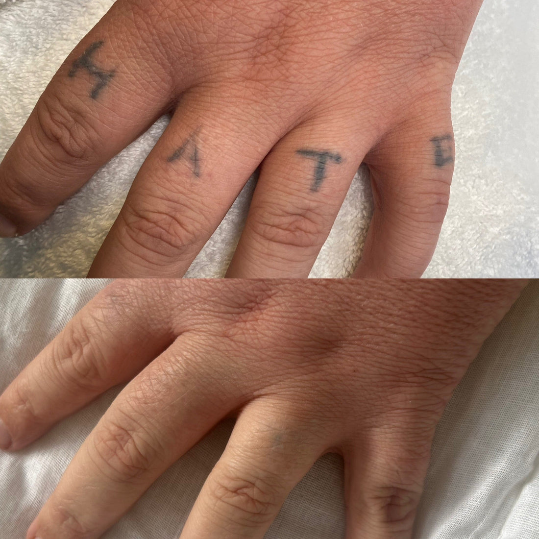 Tattoo removal before and after