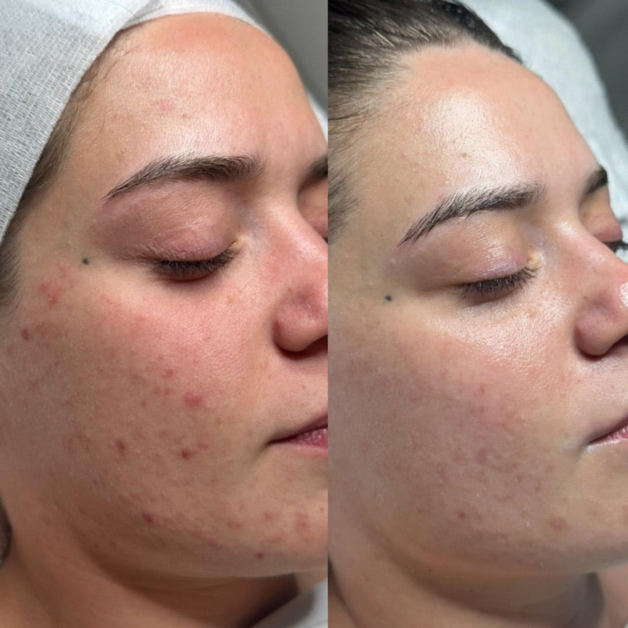 Microdermabrasion Before and Afters + Treatment Guide