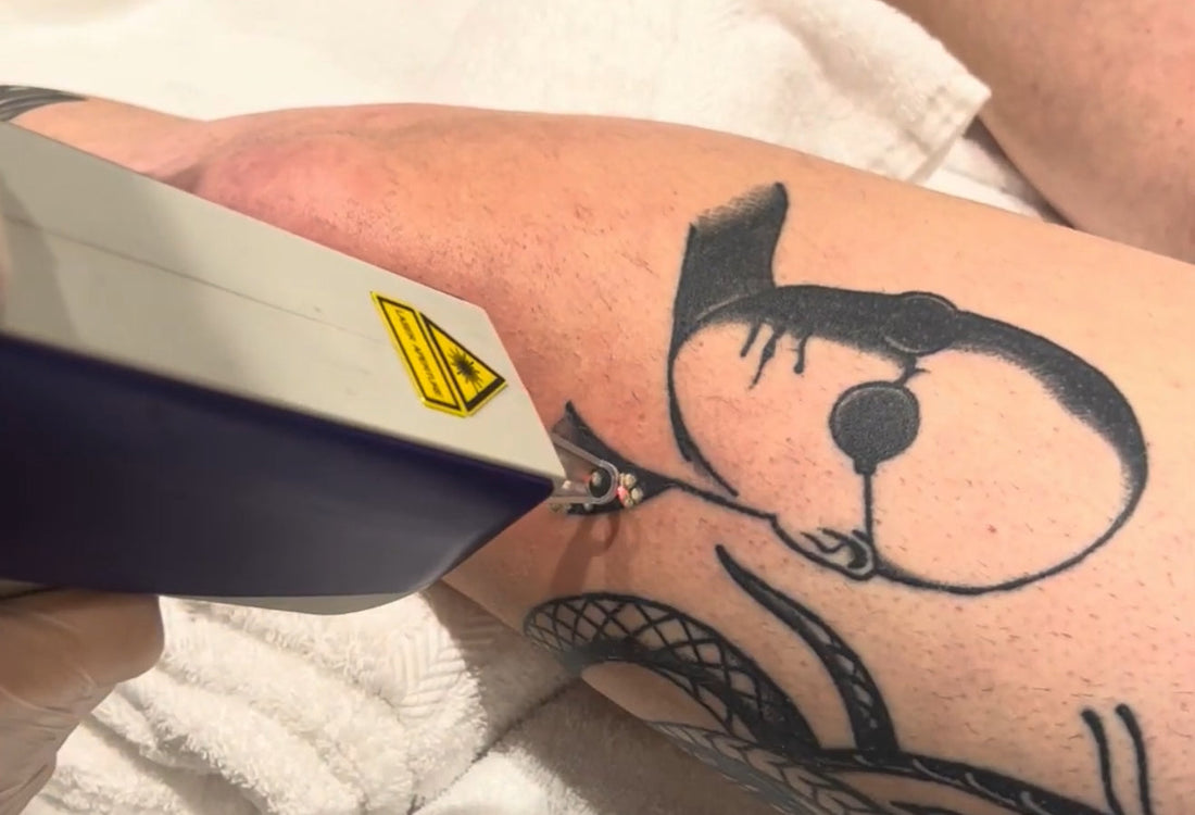Does Laser Tattoo Removal Work?